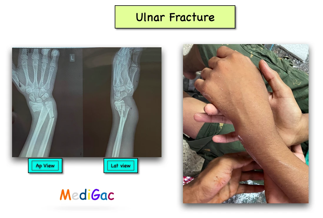 Ulnar fracture